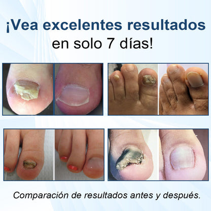 ⚡Resultados en dos días + reparación de calidad profesional 🏥CureVivo® MycoShield Pro Parches para uñas con hongos🎁🎁🎁