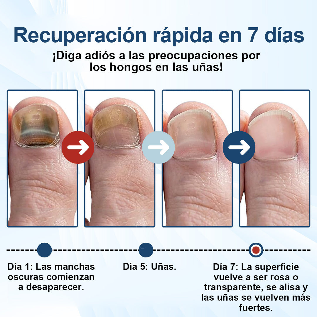 ⚡Resultados en dos días + reparación de calidad profesional 🏥CureVivo® MycoShield Pro Parches para uñas con hongos🎁🎁🎁