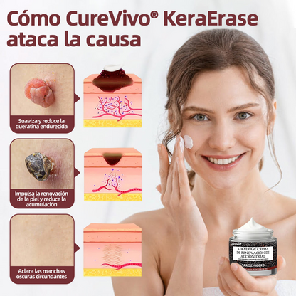 Tienda oficial🩺丨 CureVivo® KeraErase Crema Renovadora de Doble Acción🎯🎯🎯