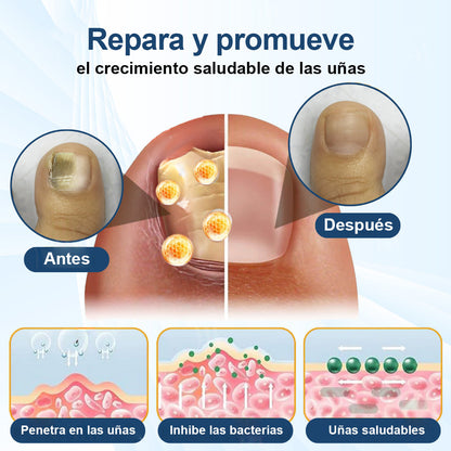 ⚡Resultados en dos días + reparación de calidad profesional 🏥CureVivo® MycoShield Pro Parches para uñas con hongos🎁🎁🎁